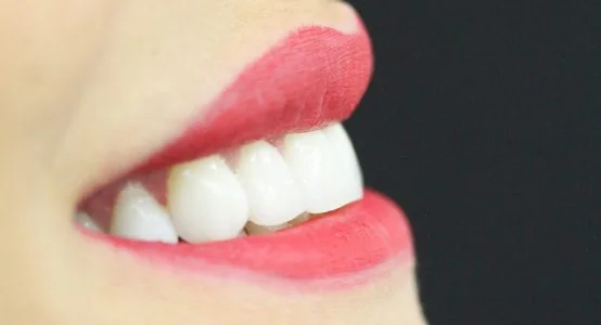 Imagem ilustrativa sobre clareamento dental