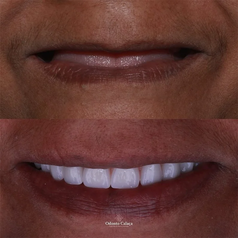 Imagem ilustrativa sobre prótese dentária